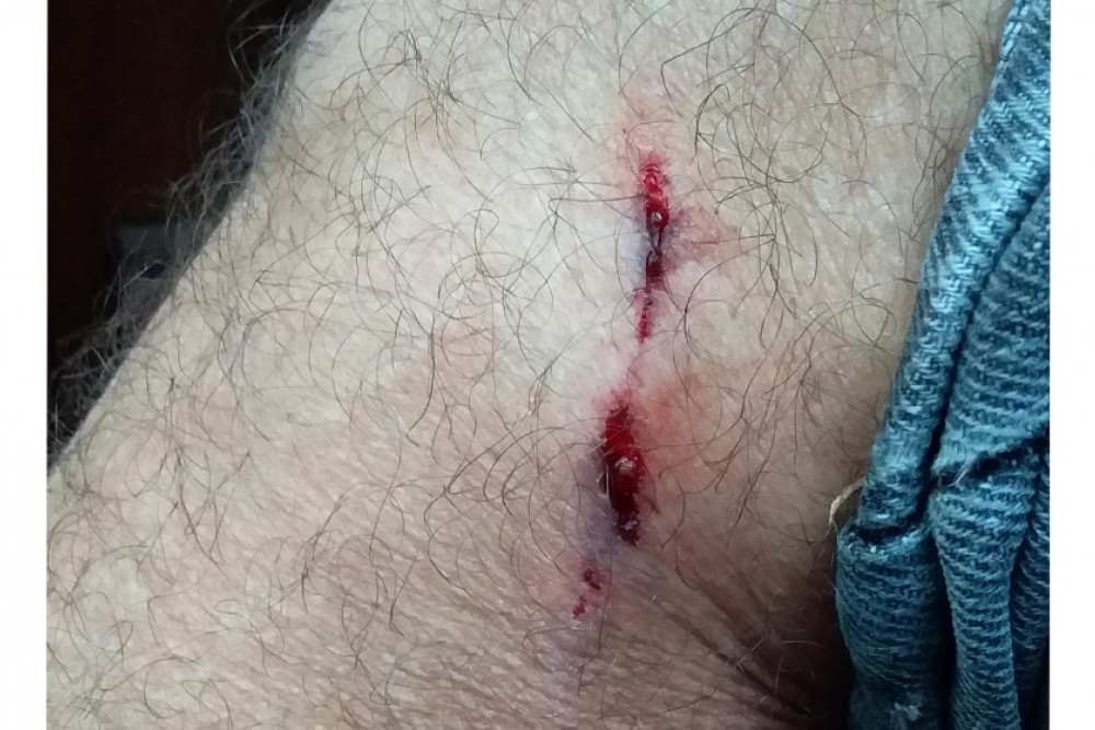 A bite from one of the dogs tore through clothing and lacerated the skin on Daniel Hicks’ leg.